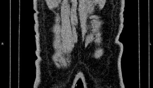 File:Adrenal myelolipoma (Radiopaedia 84321-99619 Coronal non-contrast 80).jpg