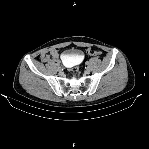 Adrenal myelolipoma (Radiopaedia 87794-104246 Axial renal excretory phase 81).jpg