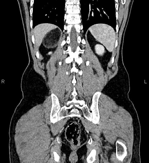Adrenal myelolipoma (Radiopaedia 87794-104246 Coronal renal cortical phase 53).jpg