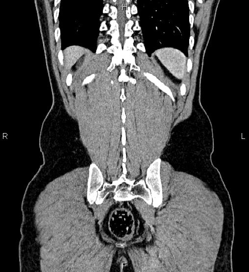 File:Adrenal myelolipoma (Radiopaedia 87794-104246 Coronal renal cortical phase 57).jpg