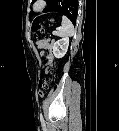 Adrenal myelolipoma (Radiopaedia 87794-104246 Sagittal renal cortical phase 76).jpg