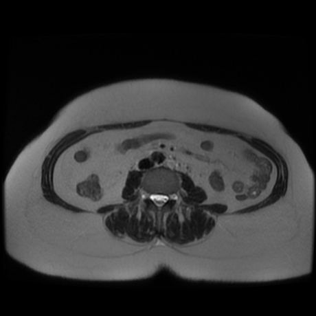 File:Adrenal myelolipoma - MRI (Radiopaedia 83249-97646 Axial T2 30).jpg