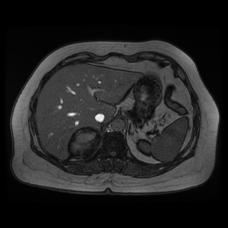 File:Adrenal myelolipoma - MRI (Radiopaedia 83249-97646 T1 out-of-phase 4).jpg