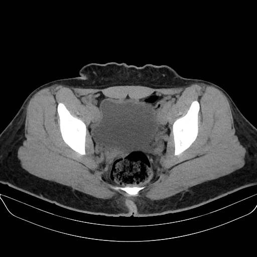 Adrenal myelolipoma - bilateral (Radiopaedia 74805-85810 Axial non-contrast 74).jpg