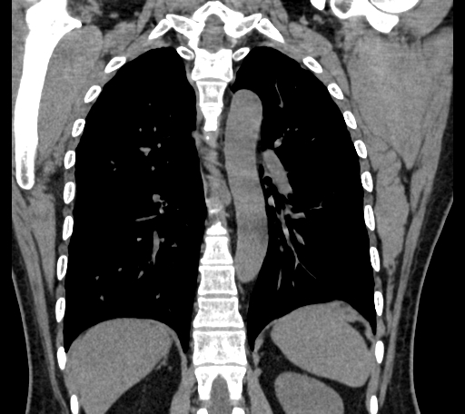 Adrenal myelolipoma - bilateral (Radiopaedia 74805-85810 Coronal C+ portal venous phase 151).jpg