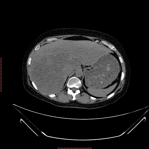 File:Adrenocortical carcinoma (Radiopaedia 80134-93438 Axial C+ portal venous phase 86).jpg