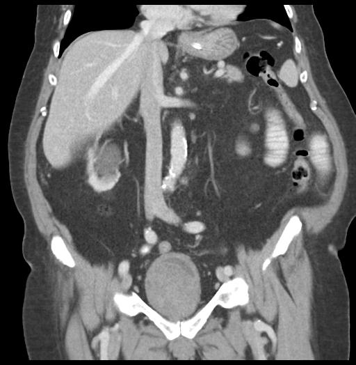 Adult ileal intussusception with secondary obstruction (Radiopaedia 30395-31051 Coronal C+ portal venous phase 32).jpg
