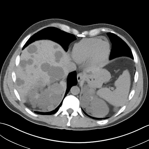 Adult polycystic kidney disease (Radiopaedia 47866-52626 Axial non-contrast 9).png