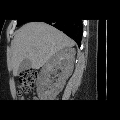 Adult polycystic kidney disease (Radiopaedia 59075-66368 Sagittal non-contrast 16).jpg