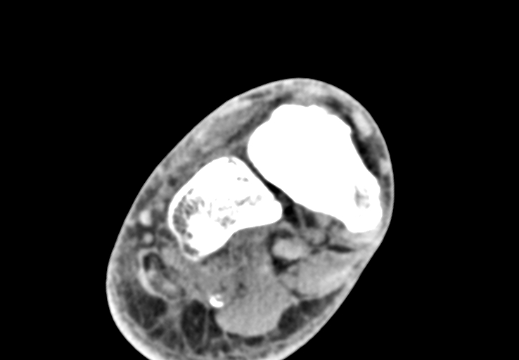 File:Advanced osteomyelitis due to open metatarsal fracture (Radiopaedia 83891-99095 Axial non-contrast 18).jpg