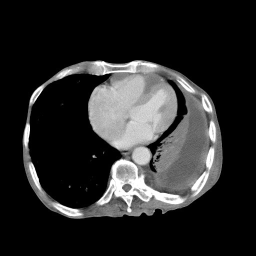 File:Aggressive lung cancer with cardiac metastases, pulmonary artery tumor thrombus, and Budd-Chiari (Radiopaedia 60320-67981 A 40).jpg