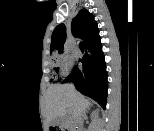File:Air bronchogram in pneumonia (Radiopaedia 85719-101512 F 38).jpg