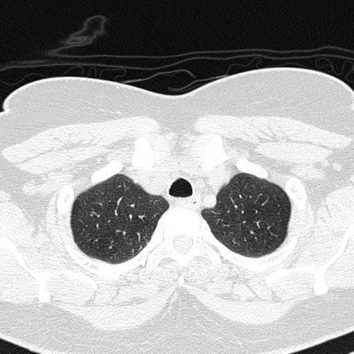 File:Air trapping in small airway disease (Radiopaedia 61685-69694 Axial lung window 25).jpg