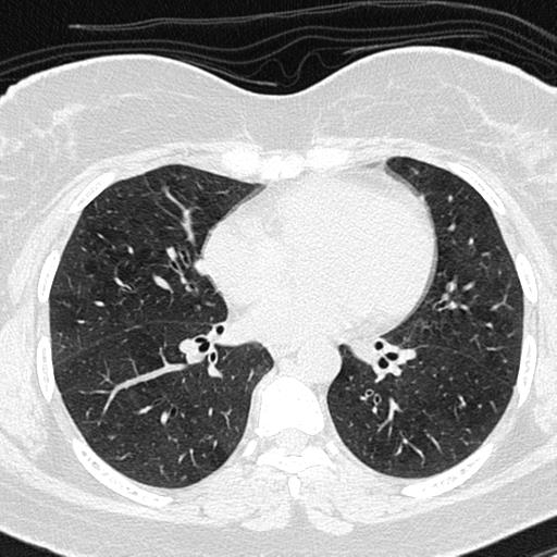 Air trapping in small airway disease (Radiopaedia 61685-69694 Axial lung window 94).jpg