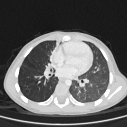 Airway foreign body (Radiopaedia 72128-82638 Axial lung window 48).jpg