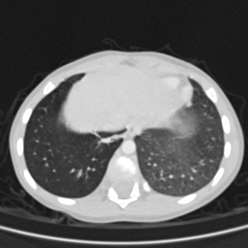 Airway foreign body (Radiopaedia 72128-82638 Axial lung window 76).jpg