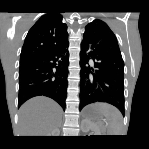 File:Alagille syndrome with pulmonary hypertension (Radiopaedia 49384-54980 C 7).jpg
