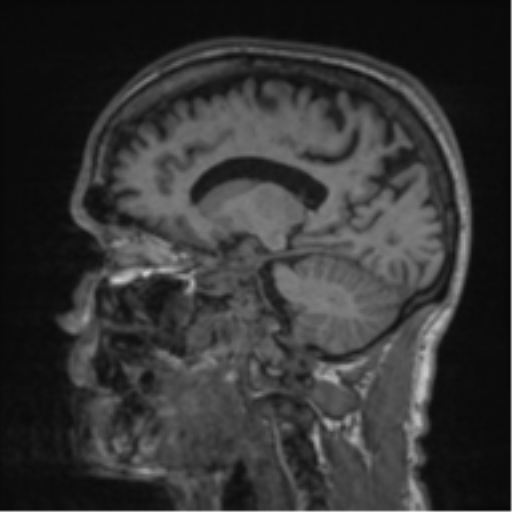 File:Alzheimer's disease- with apraxia (Radiopaedia 54763-61011 Sagittal T1 43).png