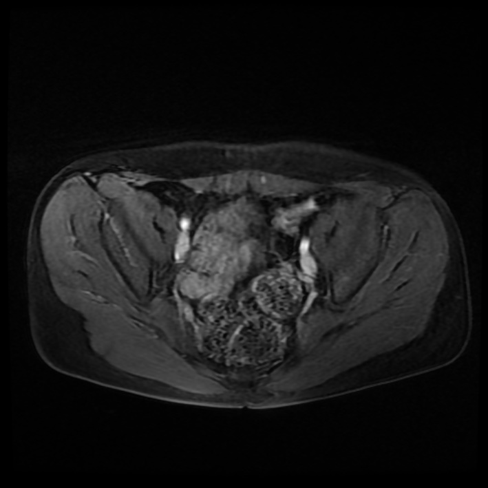 Ambiguous genitalia (Radiopaedia 69686-79643 Axial T1 C+ fat sat 20).jpg