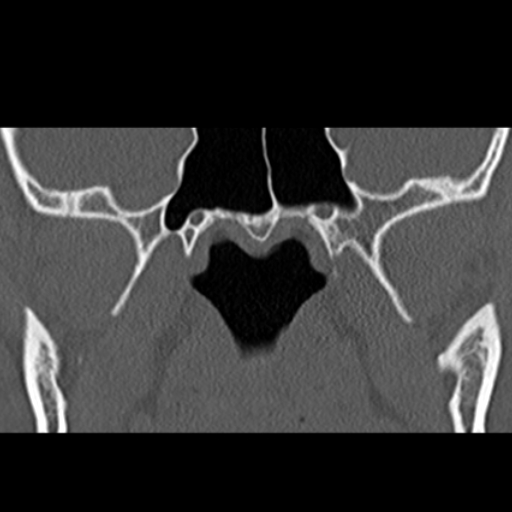 File:Ameloblastic fibro-odontoma (Radiopaedia 18843-18780 B 24).jpg