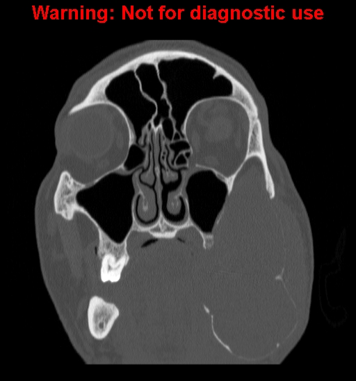 File:Ameloblastoma (Radiopaedia 13276-13280 Coronal non-contrast 9).jpg