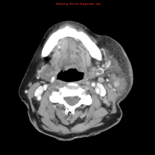 Ameloblastoma (Radiopaedia 27437-27631 A 50).jpg