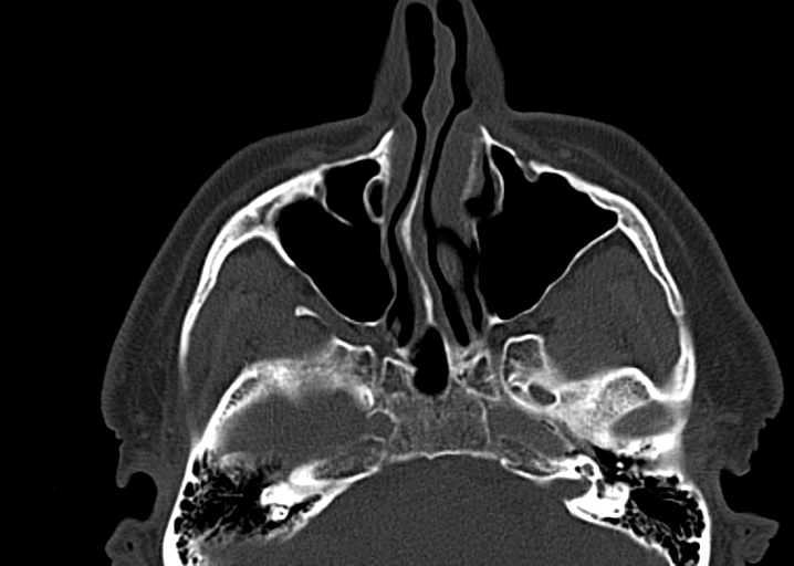 Ameloblastoma (Radiopaedia 38520-40623 D 12).png