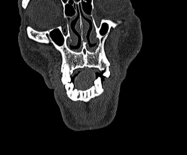 Ameloblastoma (Radiopaedia 51921-57766 Coronal bone window 29).jpg