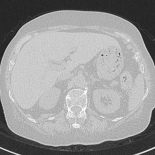 Amiodarone-induced pulmonary fibrosis (Radiopaedia 82355-96460 Axial lung window 70).jpg