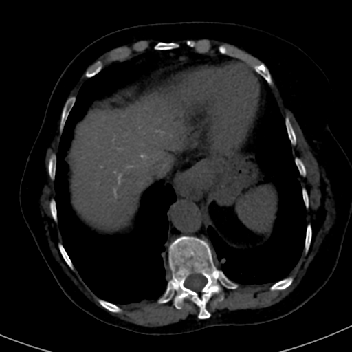File:Ampullary adenocarcinoma (Radiopaedia 34013-35241 AXIAL THICK 10).png