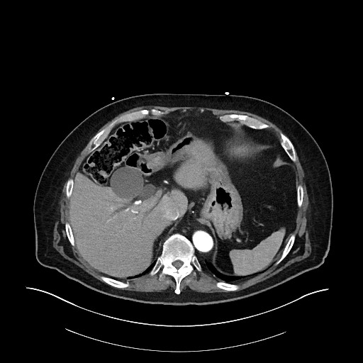 Ampullary adenocarcinoma (Radiopaedia 59373-66734 A 41).jpg