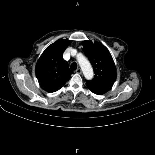 File:Ampullary adenocarcinoma (Radiopaedia 86093-102033 B 22).jpg