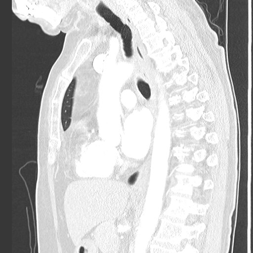 Amyloidosis - bronchial and diffuse nodular pulmonary involvement (Radiopaedia 60156-67745 Sagittal lung window 48).jpg