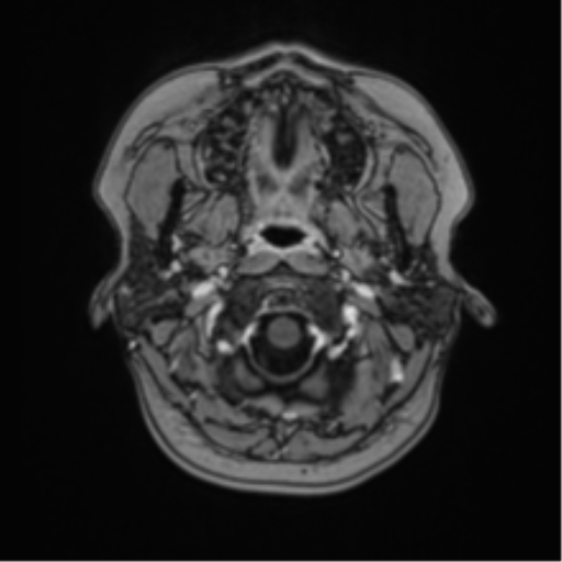 Anaplastic astroblastoma (Radiopaedia 55666-62194 Axial T1 C+ 5).png