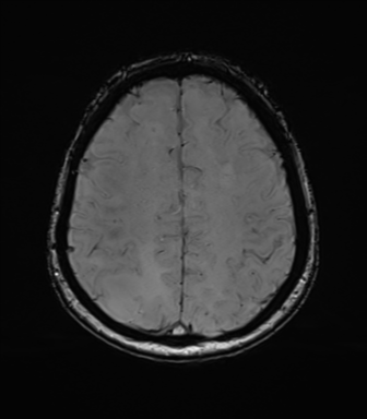 Anaplastic astrocytoma (Radiopaedia 86943-103160 Axial SWI 66).png