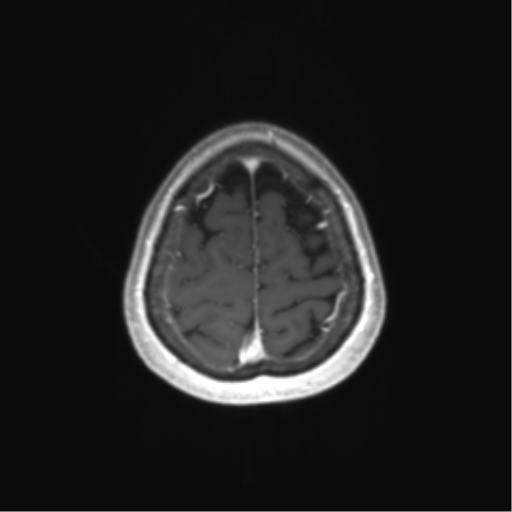 File:Anaplastic astrocytoma (Radiopaedia 86943-103160 Axial T1 C+ 80).png