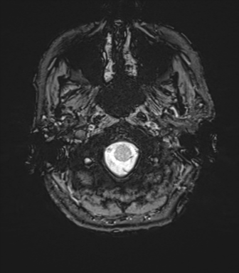 Anaplastic astrocytoma - thalamic glioma (Radiopaedia 59709-67115 G 5).png