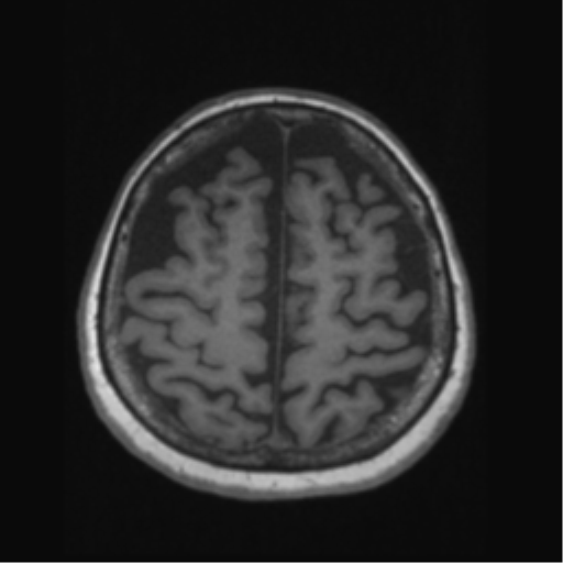 Anaplastic astrocytoma IDH wild-type (pseudoprogression) (Radiopaedia 42209-45276 Axial T1 116).png