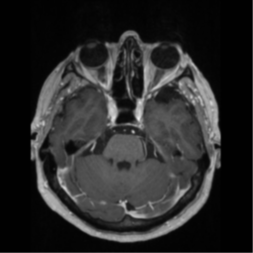 File:Anaplastic astrocytoma IDH wild-type (pseudoprogression) (Radiopaedia 42209-45276 Axial T1 C+ 51).png
