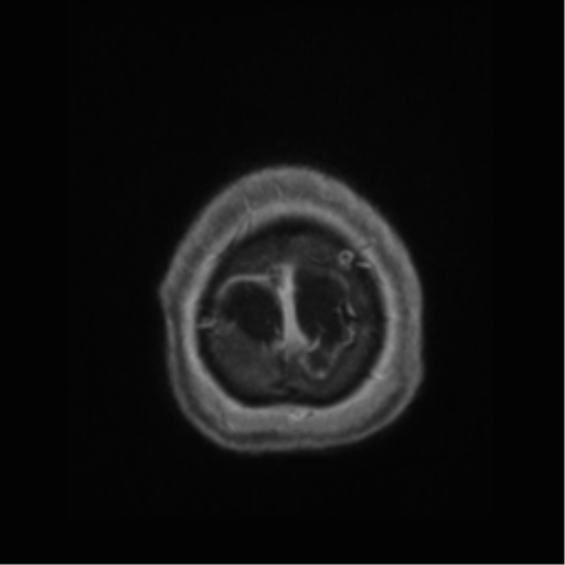 Anaplastic astrocytoma IDH wild-type (pseudoprogression) (Radiopaedia 42209-45277 Axial T1 C+ 126).png