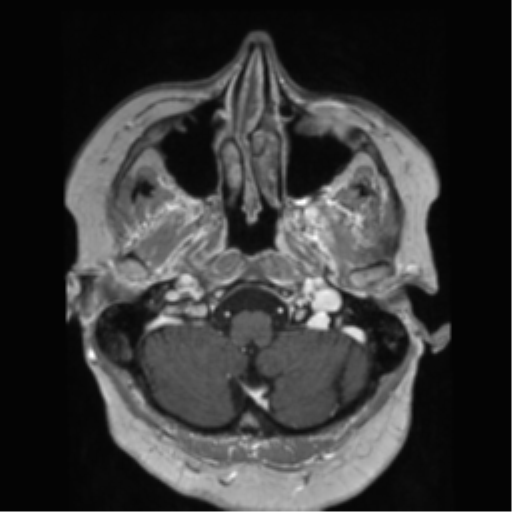 File:Anaplastic astrocytoma IDH wild-type (pseudoprogression) (Radiopaedia 42209-45278 Axial T1 C+ 33).png