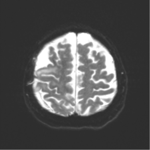 File:Anaplastic astrocytoma IDH wild-type (pseudoprogression) (Radiopaedia 42209-45279 Axial DWI 21).png