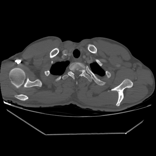 Aneurysmal bone cyst - rib (Radiopaedia 82167-96220 Axial bone window 47).jpg