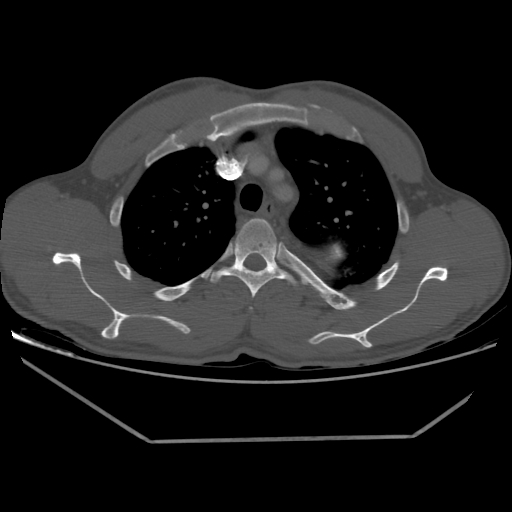 Aneurysmal bone cyst - rib (Radiopaedia 82167-96220 Axial bone window 87).jpg