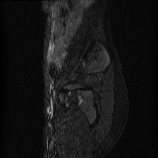 File:Aneurysmal bone cyst - sacrum (Radiopaedia 65190-74196 Sagittal STIR 25).jpg