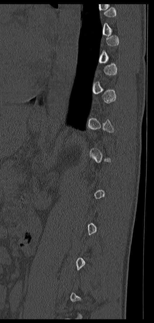 Aneurysmal bone cyst T11 (Radiopaedia 29294-29721 Sagittal bone window 22).jpg