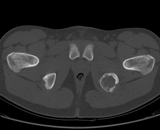 File:Aneurysmal bone cyst of ischium (Radiopaedia 25957-26094 Axial bone window 69).png