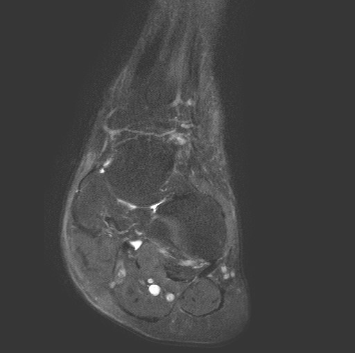 File:Aneurysmal bone cyst of the calcaneus (Radiopaedia 60669-68420 Coronal T2 fat sat 2).jpg