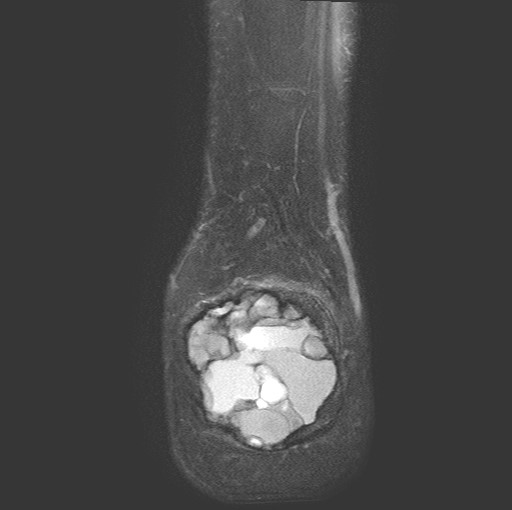 File:Aneurysmal bone cyst of the calcaneus (Radiopaedia 60669-68420 Coronal T2 fat sat 21).jpg