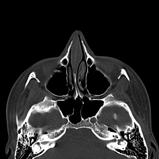 File:Aneurysmal bone cyst of the mandible (Radiopaedia 43280-46601 Axial bone window 84).jpg